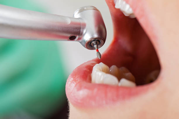 Best Teeth Whitening  in Orchards, WA